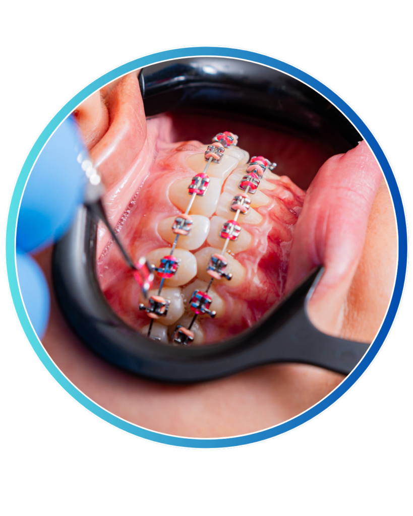 Orthodontic Braces Treatments in Bangalore