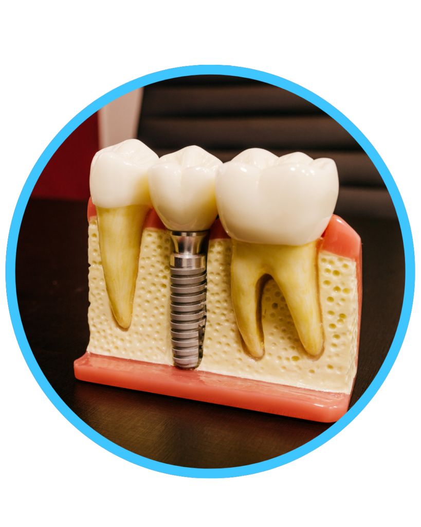 Best Dental Implant in Bangalore
