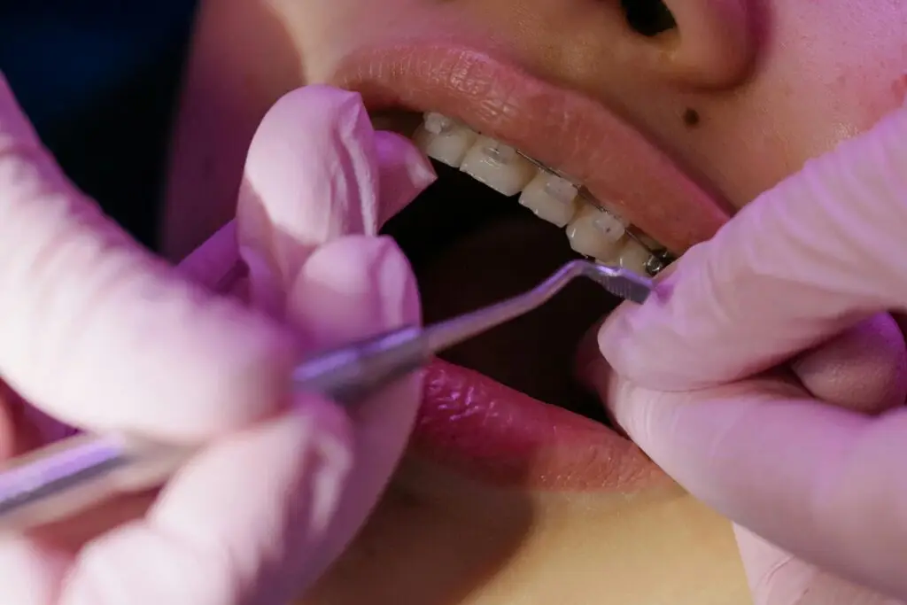Ceramic Braces treatments
