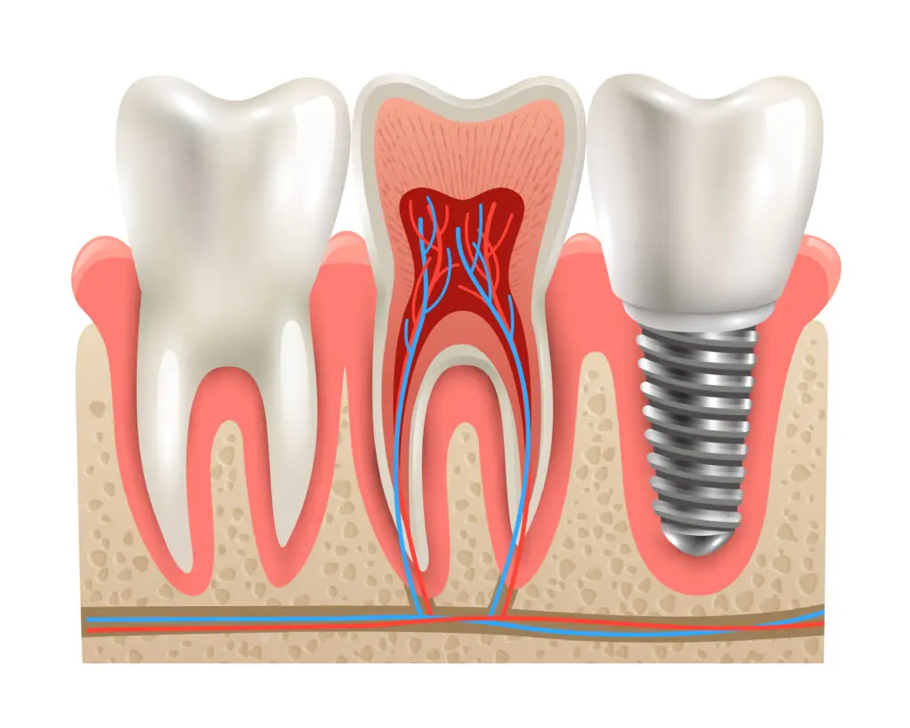 Root Canal treatments in Bangalore